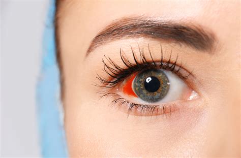 Are Broken Blood Vessels in Your Eye Dangerous? | Mississauga