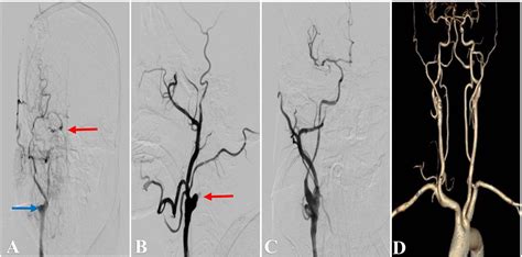 Occluded Left Internal Carotid Artery