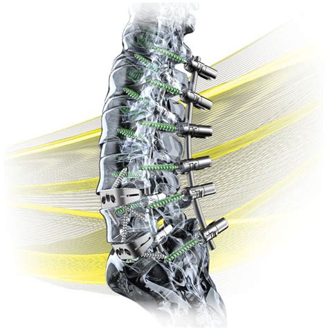 What are Spinal implants? - Siora Surgicals Private Limited