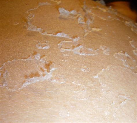 Archivo:Skin peeling.jpg - Wikipedia, la enciclopedia libre