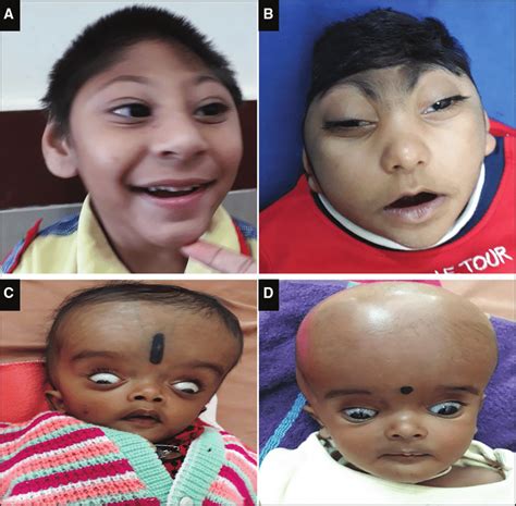 Clinical photographs showing severe microcephaly (A and B) and... | Download Scientific Diagram