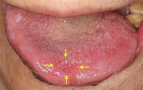 The Very First Changes in the Tongue with the Development of Cancer