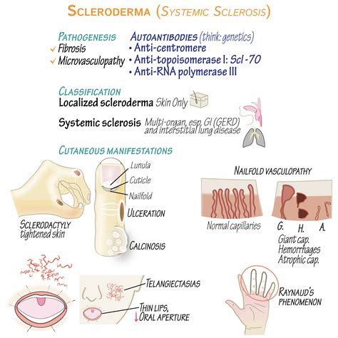 Scleroderma - Clinical Pathology Flashcards | ditki medical and biological sciences