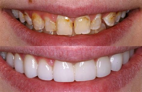 Veneers Before and After Photos - NewMouth