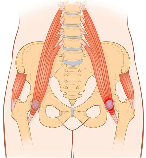 Iliopsoas Bursitis/Tendonitis | Upswing Health