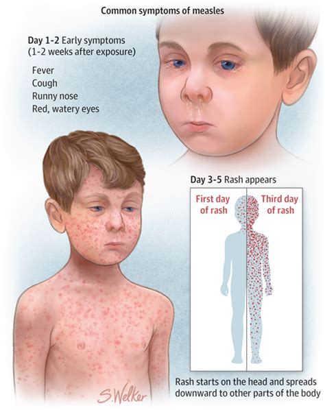 Recognizing Measles | Infectious Diseases | JAMA | The JAMA Network