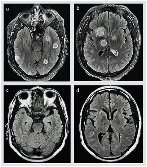 An Uncommon Cause of Ring-Enhancing Brain Lesion: Cerebral ...