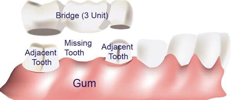 Selecting Different Types of Dental Bridges - Gentle Breeze Dental