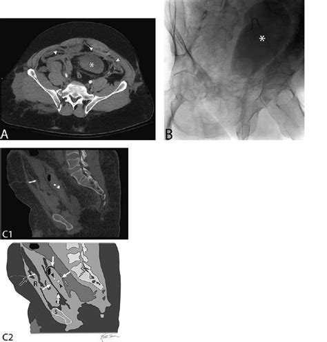 Suprapubic Cystostomy