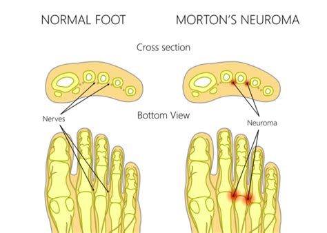 Morton's Neuroma Surgery | Foot Surgeon | Vail, Frisco, Denver CO