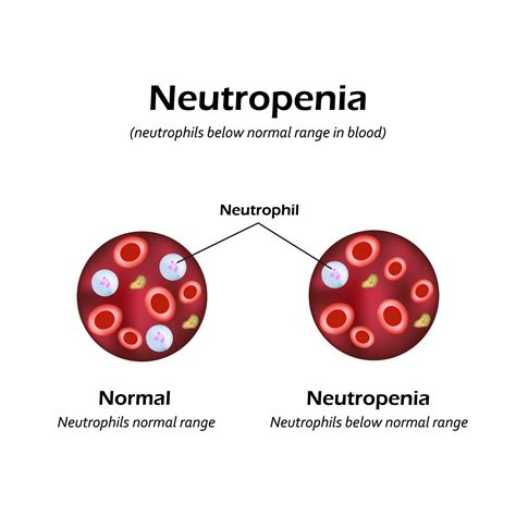 Neutropenia Przyczyny Objawy Leczenie Rozpoznanie Diagnostyka | My XXX Hot Girl