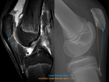 Patella alta | Radiology Reference Article | Radiopaedia.org