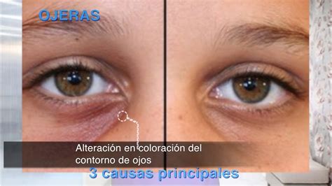 ojeras causas eliminar tratamiento - YouTube