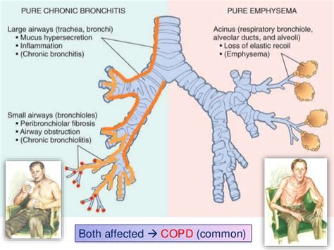 Chronic Obstructive Pulmonary Disease (COPD) - Stepwards