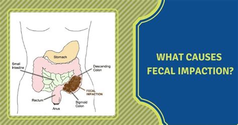 Causes of Faecal Impaction - Dr Maran - Springfield Wellness Centre | Bariatric and Metabolic ...