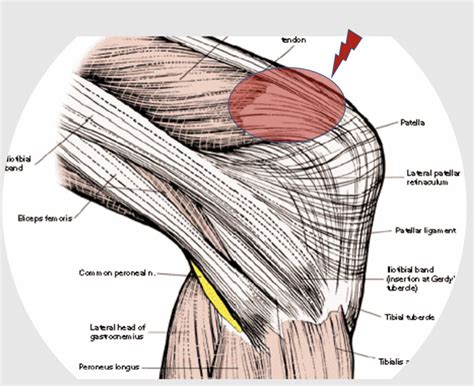 Quadriceps Tendonitis: Knee Tendonitis - Dr. Justin Dean