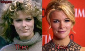 Megyn Kelly Plastic Surgery, Before and After Botox Pictures