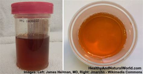 Dark Urine: What Does It Mean? Causes and Treatments