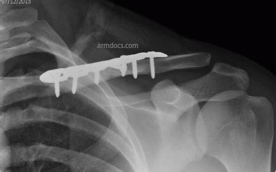 Rehabilitation after operative fixation of Clavicle fractures | Arm Docs