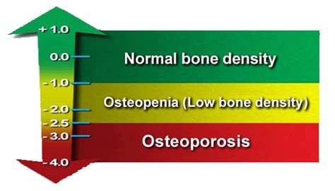 » Osteoporosis and Bone Density: Solutions and Perspectives – 176