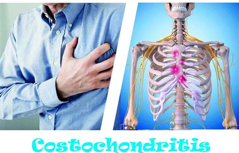 Costochondritis - Causes, Symptoms, Locations, Duration & Treatment