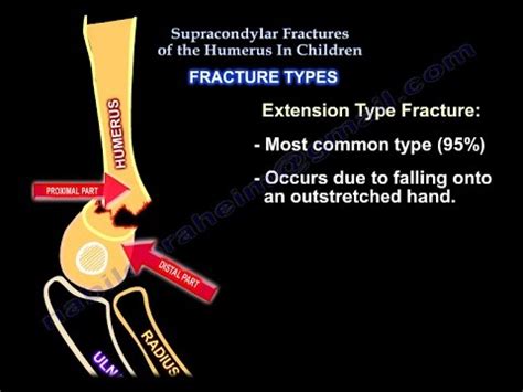 Supracondylar Fractures Of The Humerus In Children - YouTube