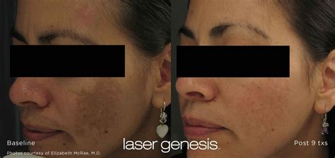 Laser Genesis | Benefits | Cost | Orange County