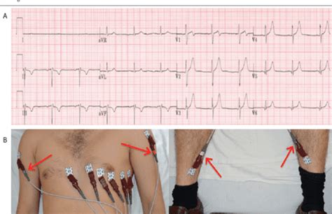 Figure 6 from Common ECG Lead Placement Errors. Part I: Limb Lead Reversals | Semantic Scholar