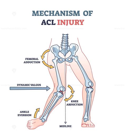 Mechanism of ACL injury as knee trauma anatomical explanation outline diagram – VectorMine
