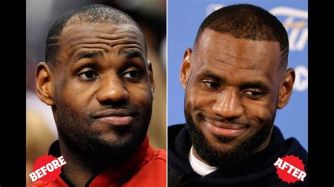 LeBron James - Hair Transplant - YouTube