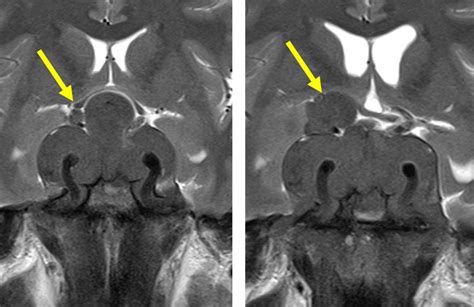 Recurrent non-functioning pituitary adenoma – Radiology Cases