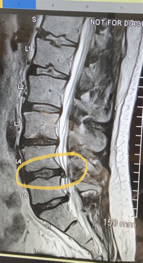 MRI -Herniated L4-L5 disc - the herniated portion of the disc is ...