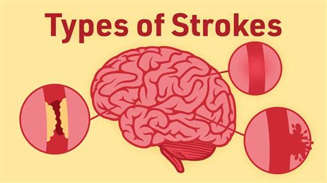 Different Types of Stroke | Ausmed