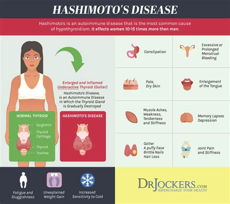 Pin on Hashimoto/ hypothyroid Issues