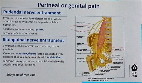 Ilioinguinal Nerve Entrapment