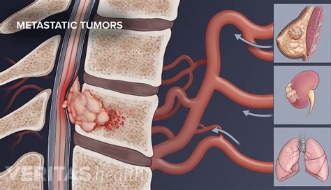 Metastatic Spine Tumors | Spine-health