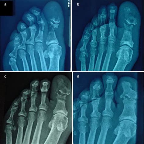 a, b Left foot of the patient. a 1st toe at initial visit (“sausage ...