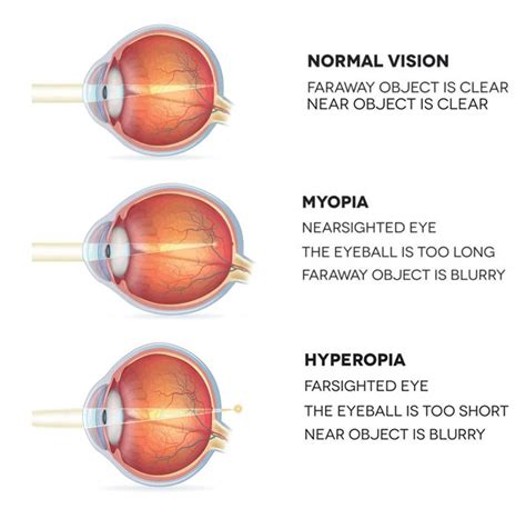 What is Nearsighted and Farsighted Vision? - InVision Optical