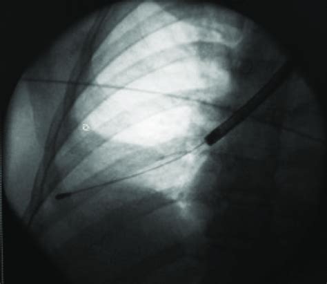 -Fluoroscopic view of the cryoprobe. | Download Scientific Diagram