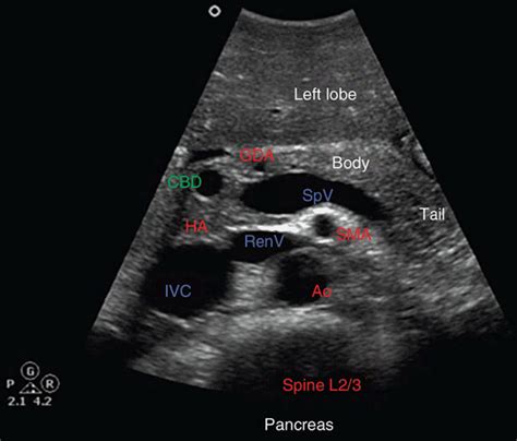 Ultrasound of the Pancreas | Radiology Key