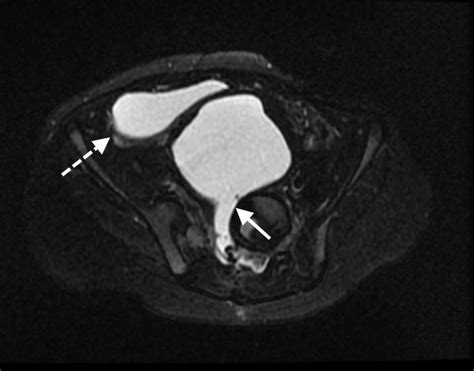 2-year-old male with an anorectal malformation and large anterior... | Download Scientific Diagram