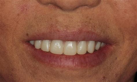 Hybrid Denture All-On-Four in Aurora CO | Before & After