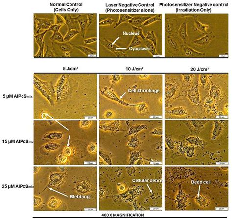 Photodynamic therapy of cervical cancer by eradication of cervical cancer cells and cervical ...