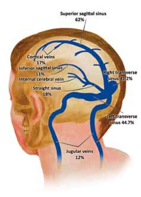 Figure 2 from Cerebral venous sinus thrombosis. | Semantic Scholar