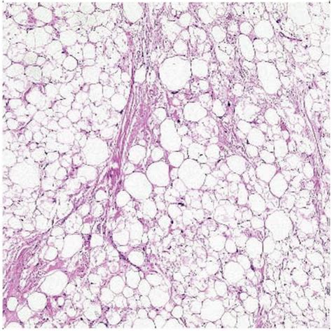 Lipoma Vs Liposarcoma Histology