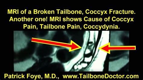 MRI of Broken Tailbone, Coccyx Fracture. See what the Radiologist ...