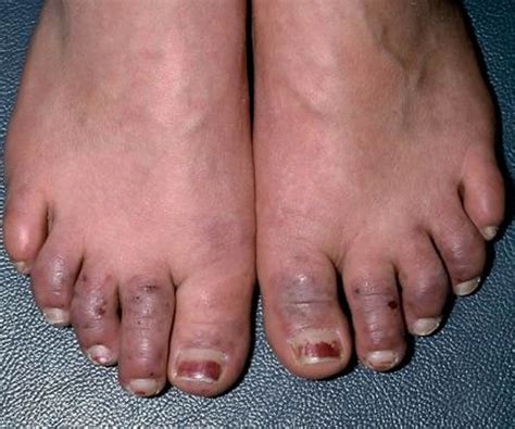 Raynaud's Disease - Causes, Symptoms, Treatment