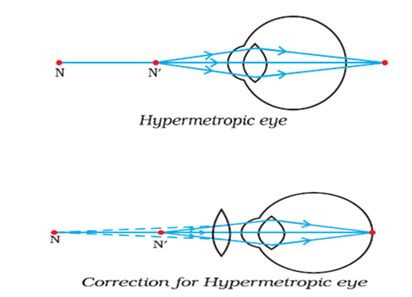 What is hypermetropia? State the two causes. With the help of labelled ...