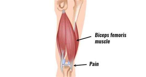 biceps femoris pain exercises Archives - Samarpan Physiotherapy Clinic