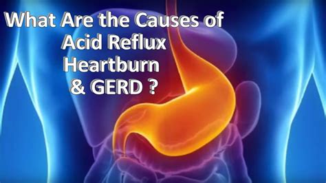 The Cause of Acid Reflux, Heartburn & GERD – Ask Nurse Mary